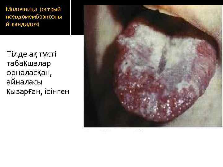 Молочница (острый псевдомембранозны й кандидоз) Тілде ақ түсті табақшалар орналасқан, айналасы қызарған, ісінген 
