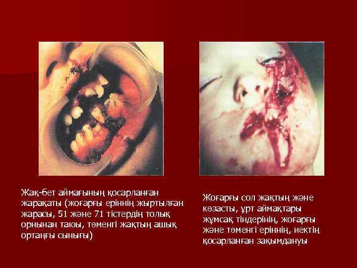 Жақ-бет аймағының қосарланған жарақаты (жоғарғы еріннің жыртылған жарасы, 51 және 71 тістердің толық орнынан