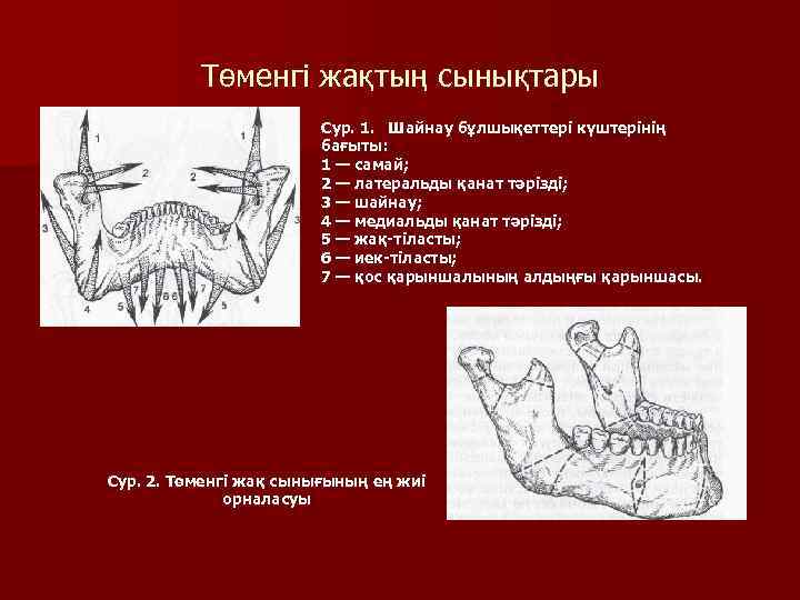 Төменгі жақтың сынықтары Сур. 1. Шайнау бұлшықеттері күштерінің бағыты: 1 — самай; 2 —
