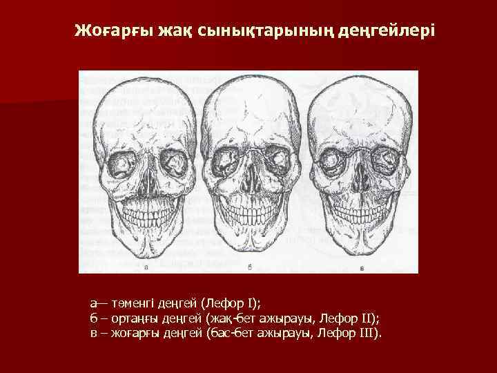 Жоғарғы жақ сынықтарының деңгейлері а— төменгі деңгей (Лефор І); б – ортаңғы деңгей (жақ-бет