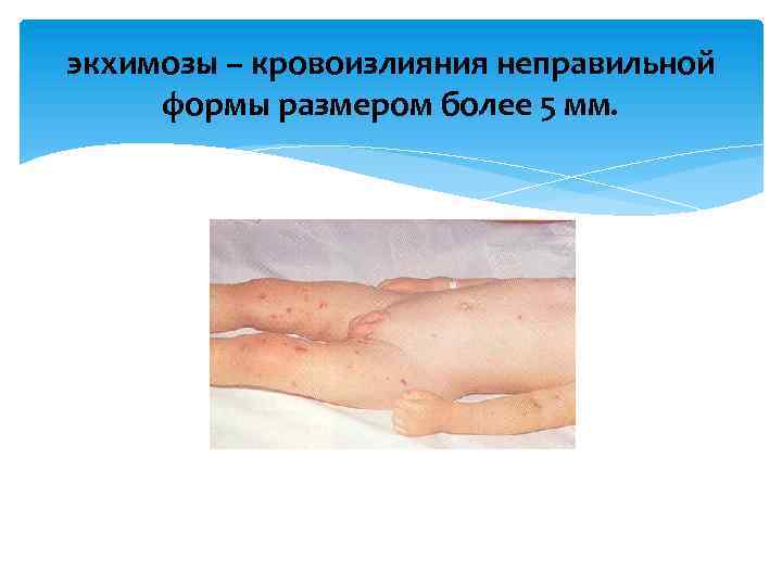 экхимозы – кровоизлияния неправильной формы размером более 5 мм. 