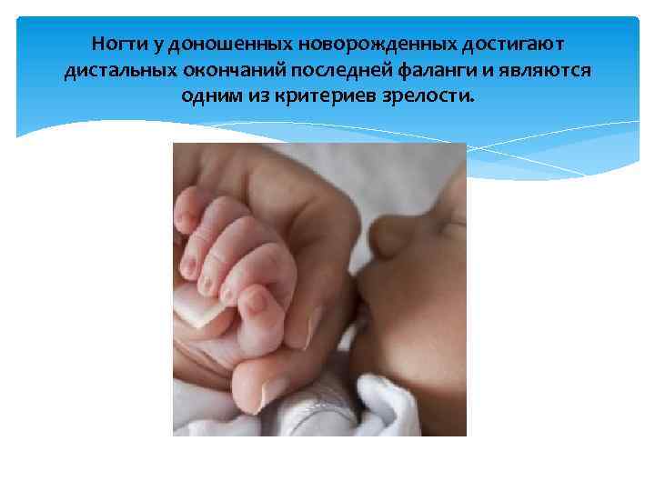 Ногти у доношенных новорожденных достигают дистальных окончаний последней фаланги и являются одним из критериев