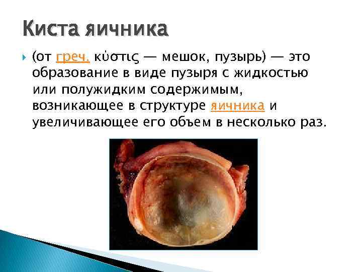 Киста яичника (от греч. κύστις — мешок, пузырь) — это образование в виде пузыря