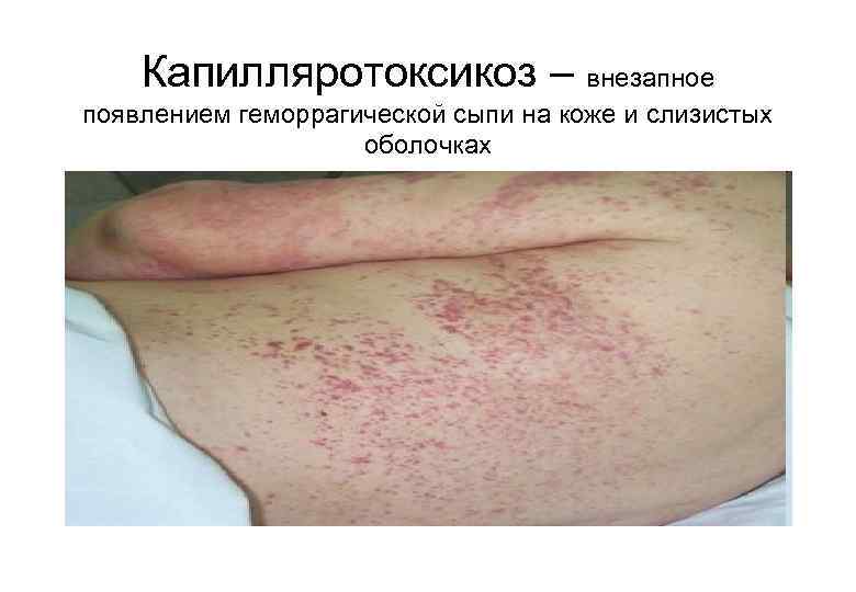 Капилляротоксикоз – внезапное появлением геморрагической сыпи на коже и слизистых оболочках 