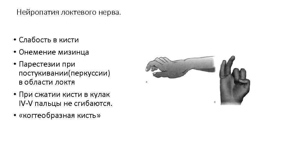 Нейропатия локтевого нерва. • Слабость в кисти • Онемение мизинца • Парестезии при постукивании(перкуссии)