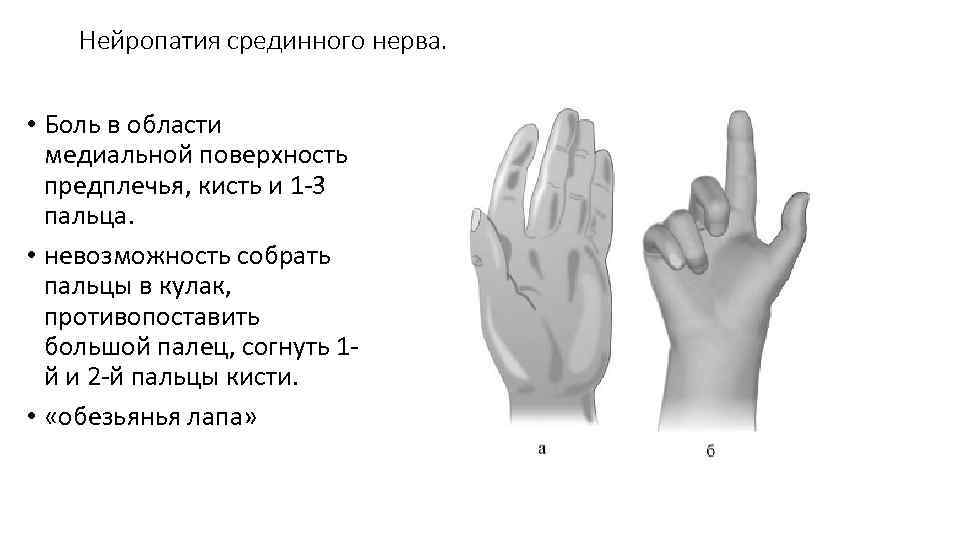 Нейропатия срединного нерва. • Боль в области медиальной поверхность предплечья, кисть и 1 3