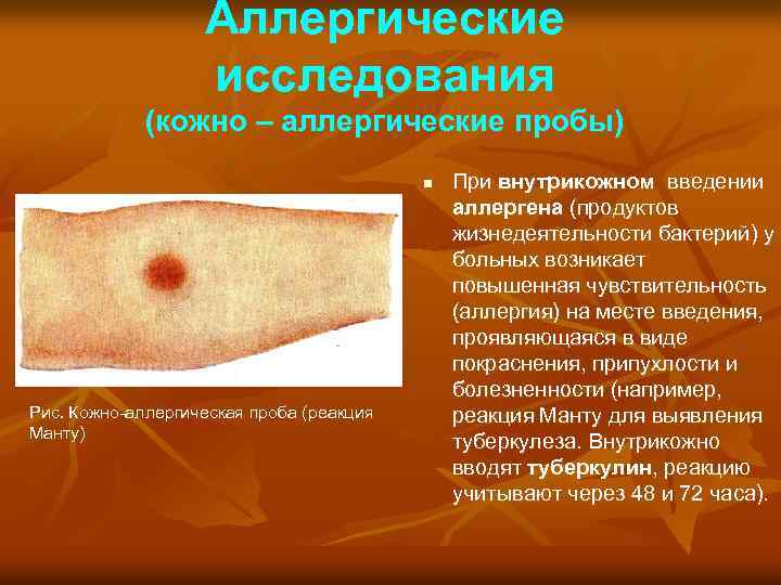 Аллергические исследования (кожно – аллергические пробы) n Рис. Кожно аллергическая проба (реакция Манту) При