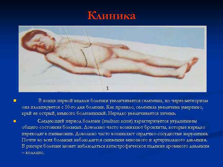 Клиника n n В конце первой недели болезни увеличивается селезенка, но через метеоризм она
