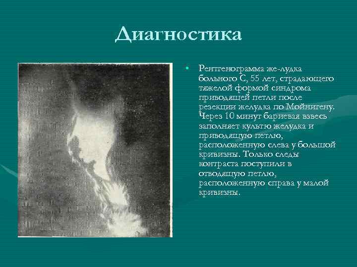 Диагностика • Рентгенограмма же лудка больного С, 55 лет, страдающего тяжелой формой синдрома приводящей