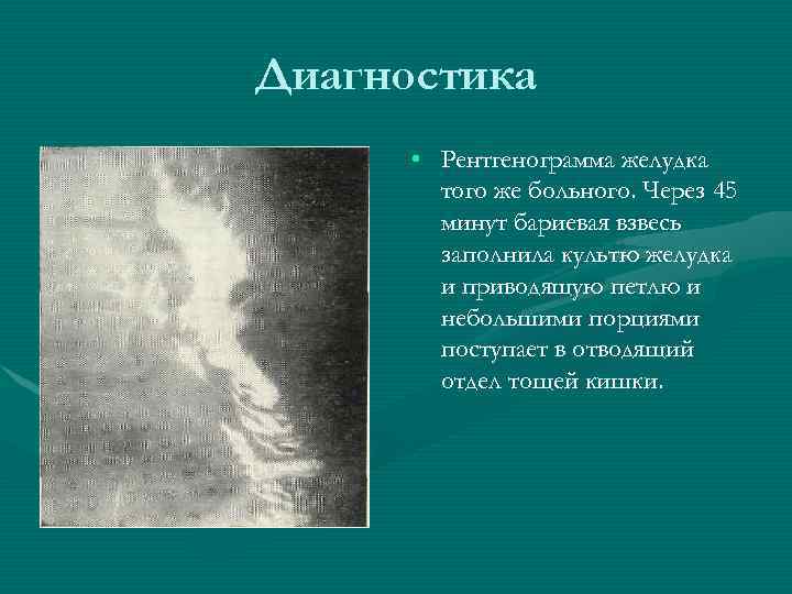 Диагностика • Рентгенограмма желудка того же больного. Через 45 минут бариевая взвесь заполнила культю