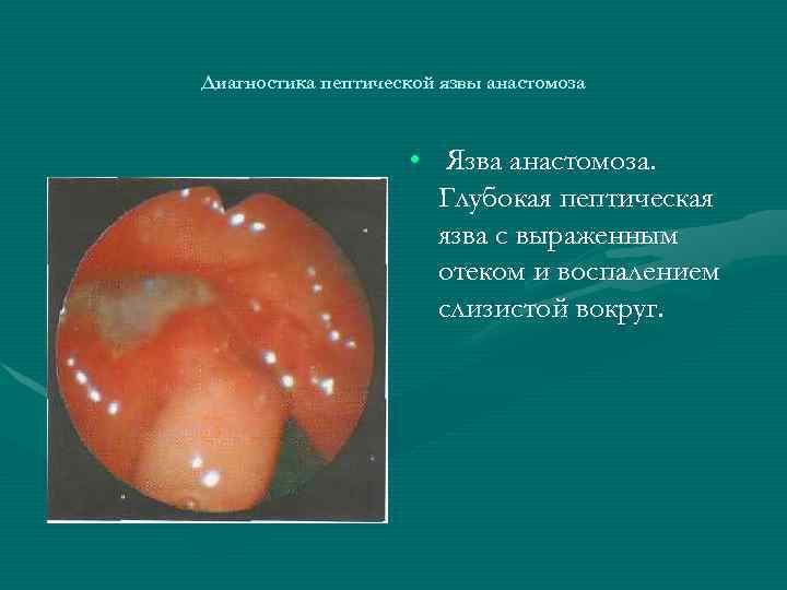 Диагностика пептической язвы анастомоза • Язва анастомоза. Глубокая пептическая язва с выраженным отеком и