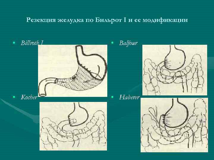 Резекция желудка по Бильрот I и ее модификации • Billroth I • Balfour •