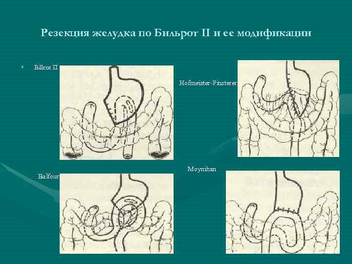 Резекция желудка по Бильрот II и ее модификации • Billrot II Hofmeister-Finsterer Balfour Moynihan