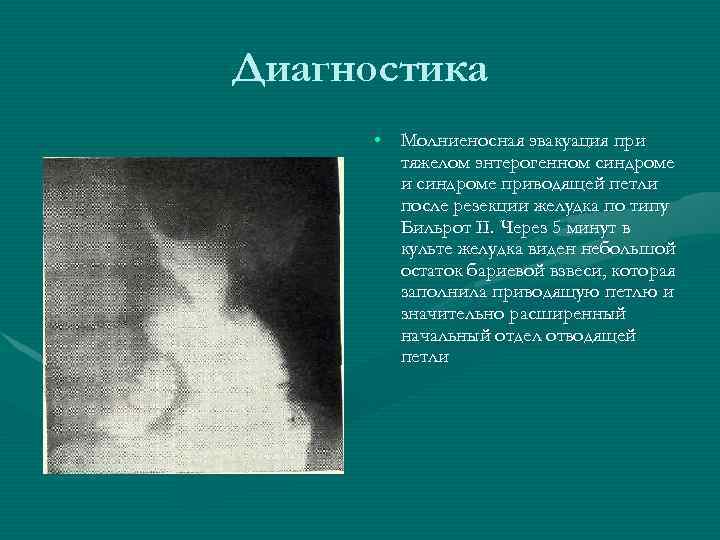 Диагностика • Молниеносная эвакуация при тяжелом энтерогенном синдроме и синдроме приводящей петли после резекции