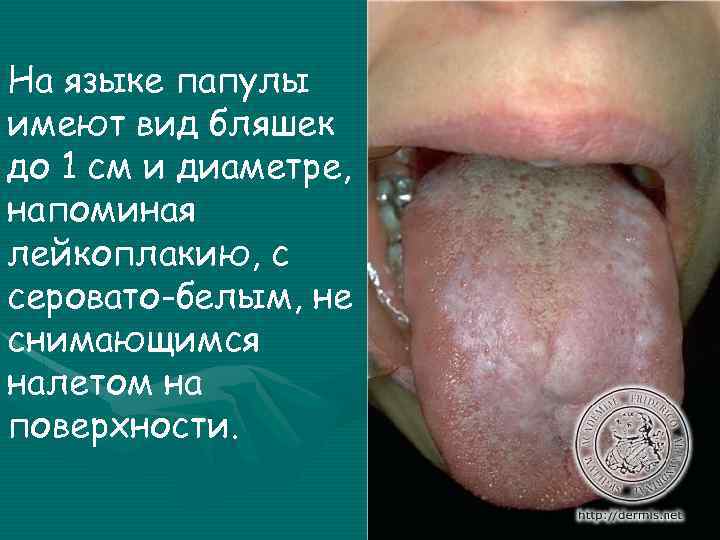На языке папулы имеют вид бляшек до 1 см и диаметре, напоминая лейкоплакию, с