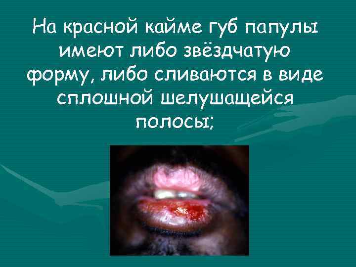 На красной кайме губ папулы имеют либо звёздчатую форму, либо сливаются в виде сплошной
