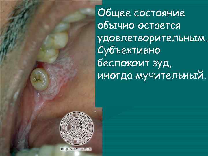 Общее состояние обычно остается удовлетворительным. Субъективно беспокоит зуд, иногда мучительный. 