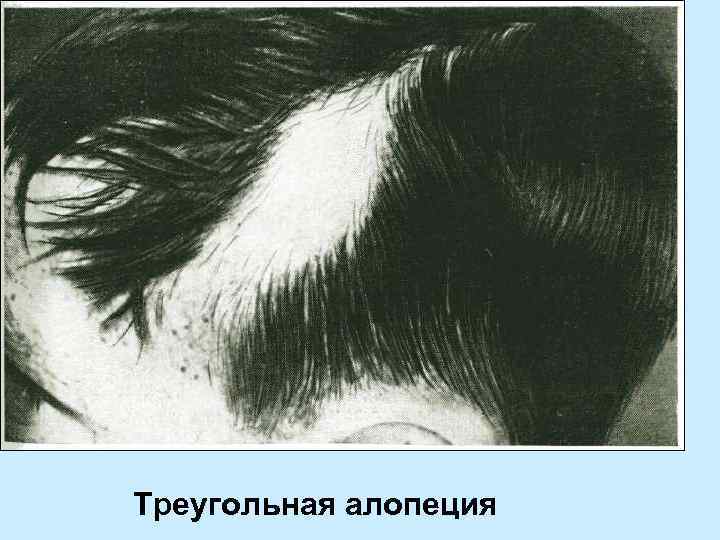 Треугольная алопеция 