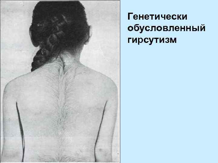 Генетически обусловленный гирсутизм 