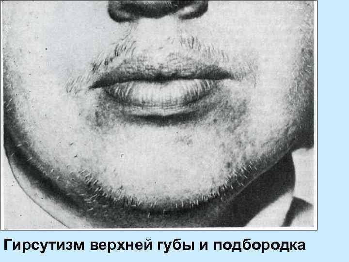 Гирсутизм верхней губы и подбородка 