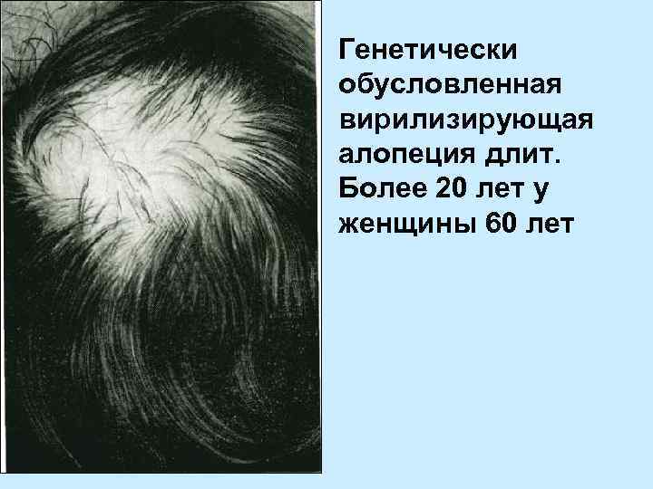 Генетически обусловленная вирилизирующая алопеция длит. Более 20 лет у женщины 60 лет 
