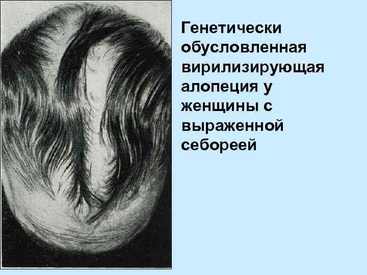 Генетически обусловленная вирилизирующая алопеция у женщины с выраженной себореей 