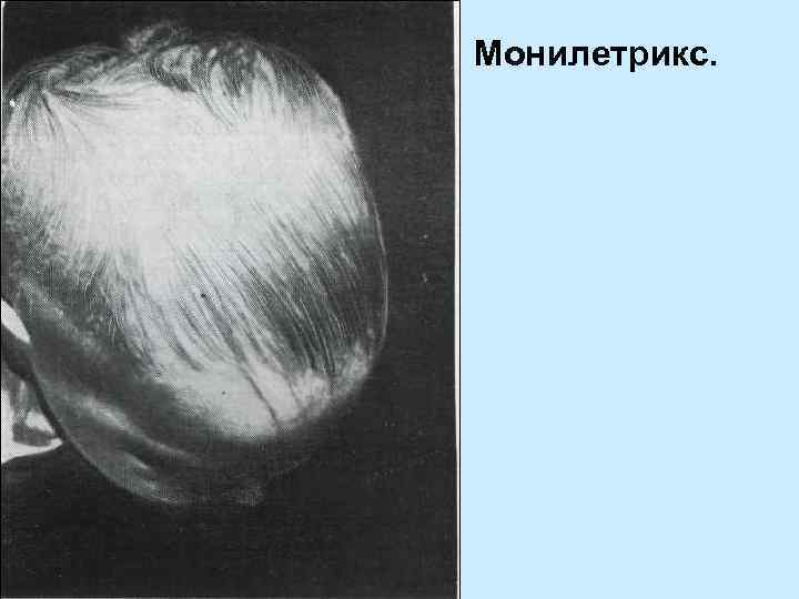 Монилетрикс. 