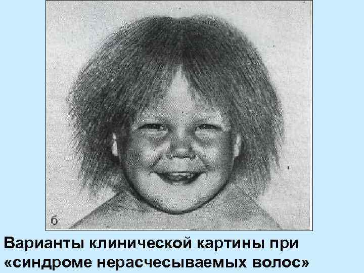 Варианты клинической картины при «синдроме нерасчесываемых волос» 