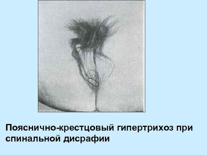 Пояснично-крестцовый гипертрихоз при спинальной дисрафии 