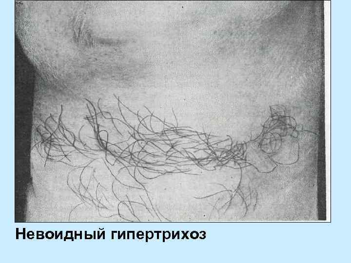 Невоидный гипертрихоз 