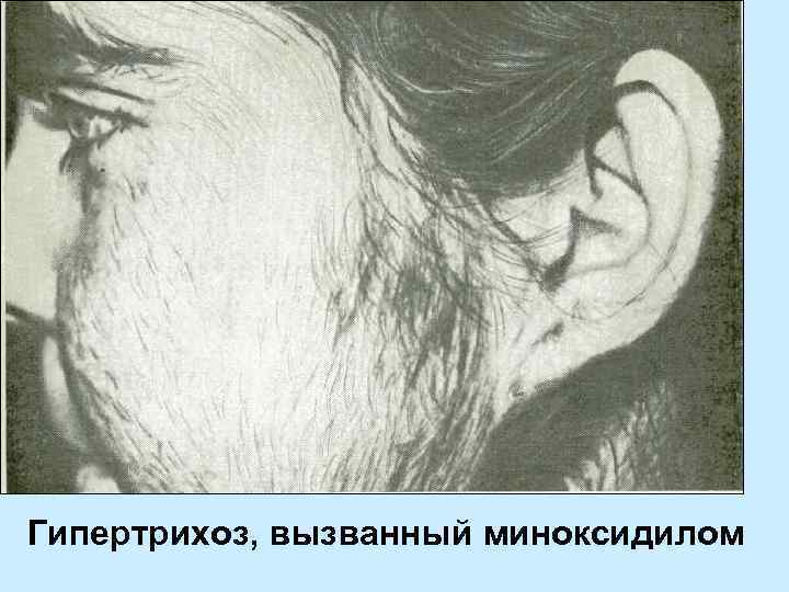 Гипертрихоз, вызванный миноксидилом 
