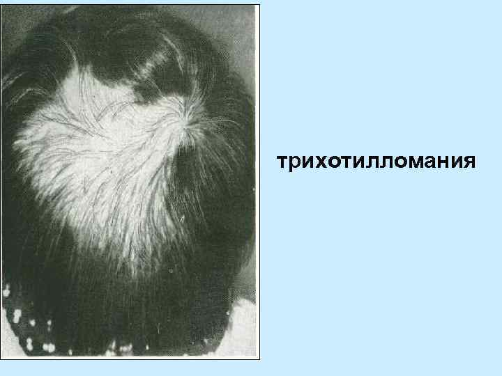 трихотилломания 