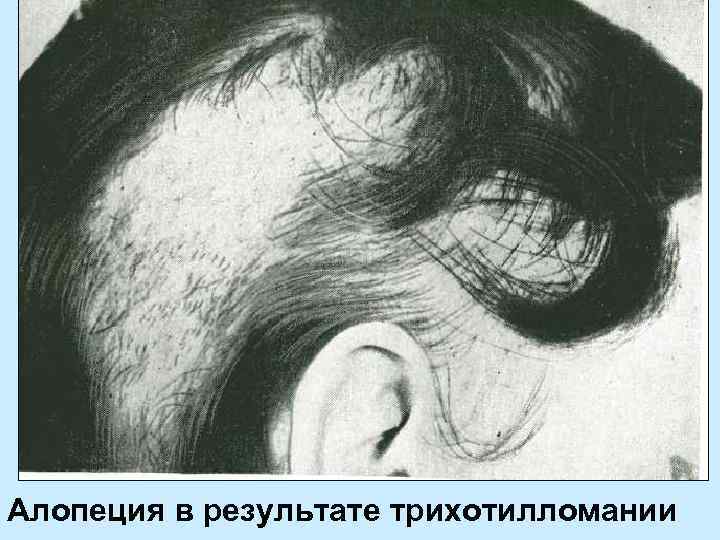Алопеция в результате трихотилломании 