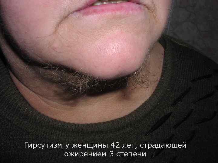 Гирсутизм у женщины 42 лет, страдающей ожирением 3 степени 