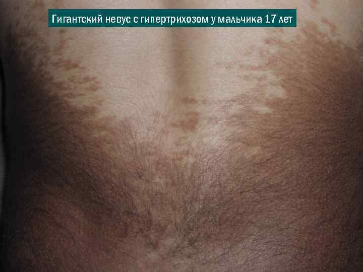 Гигантский невус с гипертрихозом у мальчика 17 лет 
