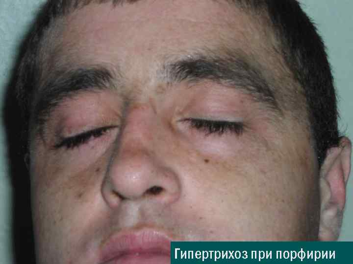Гипертрихоз при порфирии 
