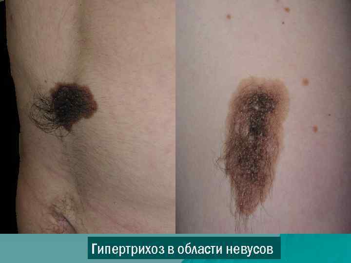 Гипертрихоз в области невусов 