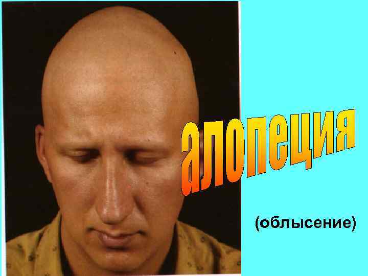 (облысение) 