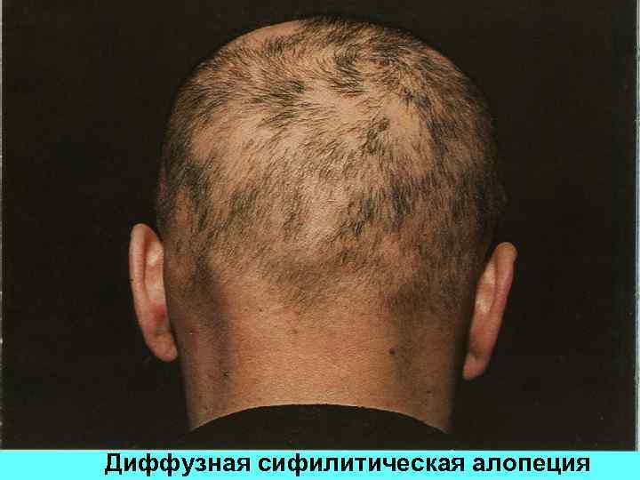 Диффузная сифилитическая алопеция 