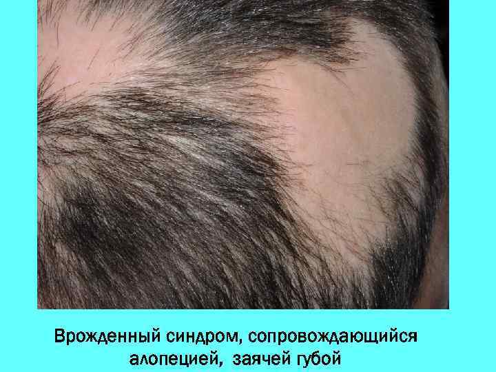 Врожденный синдром, сопровождающийся алопецией, заячей губой 