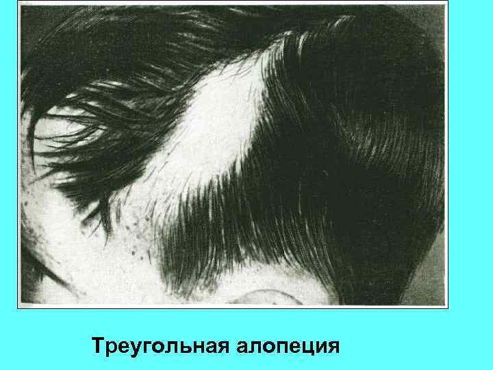 Треугольная алопеция 
