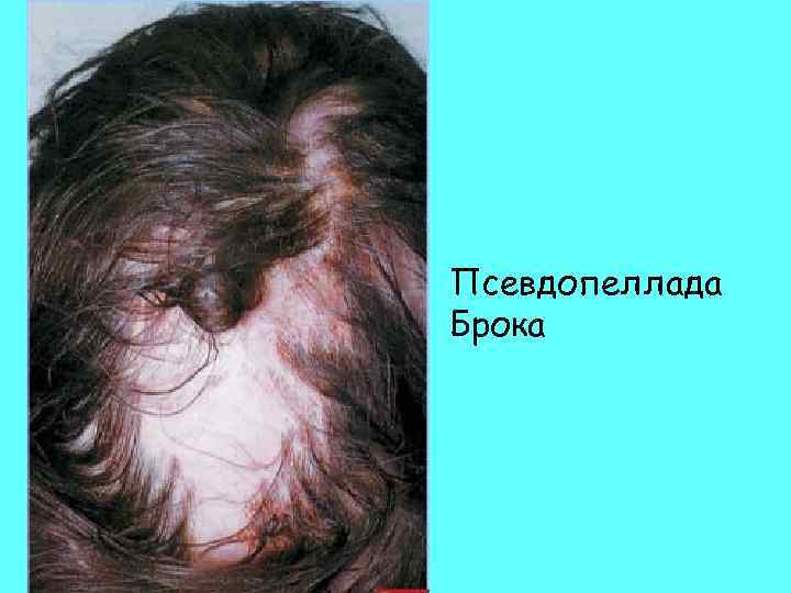 Псевдопеллада Брока 