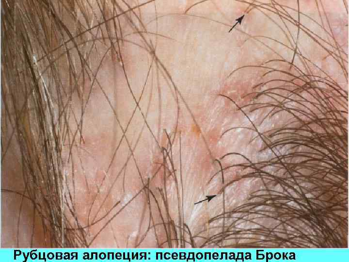 Рубцовая алопеция: псевдопелада Брока 