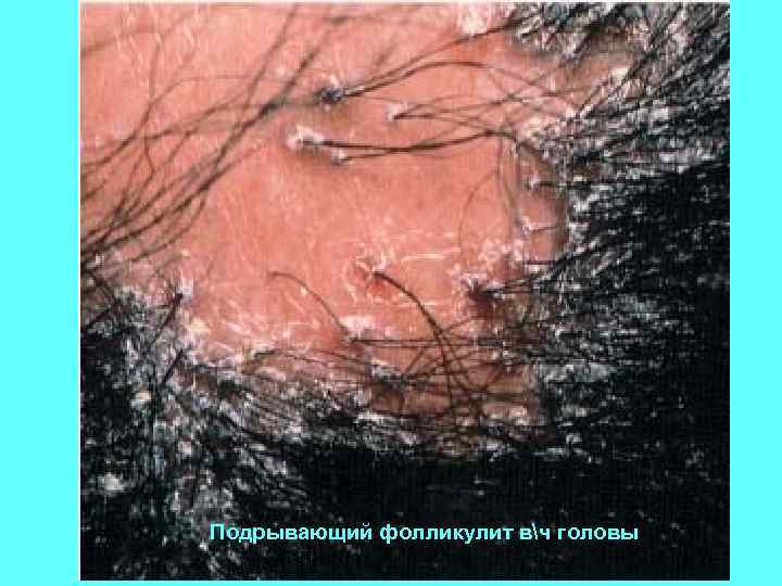 Подрывающий фолликулит вч головы 