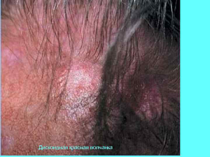 Дискоидная красная волчанка 