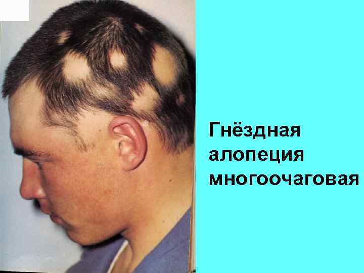 Гнёздная алопеция многоочаговая 