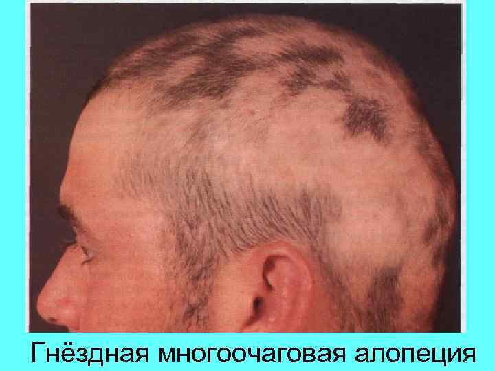Гнёздная многоочаговая алопеция 