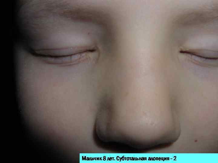 Мальчик 8 лет. Субтотальная алопеция - 2 