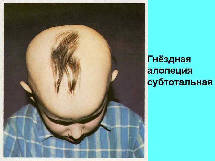 Гнёздная алопеция субтотальная 