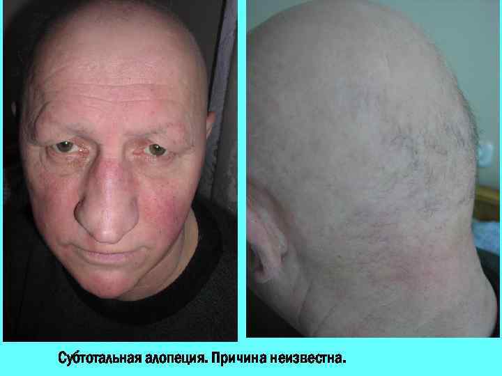 Субтотальная алопеция. Причина неизвестна. 